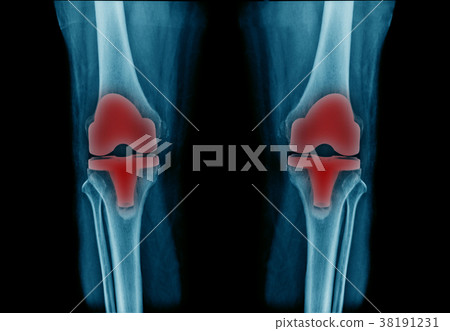 x-ray image total knee athoplasty 38191231