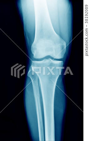 x-ray image knee joint in blue tone 38192089