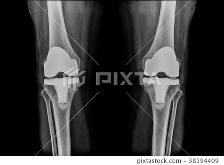 x-ray image total knee athoplasty x-ray image total knee athoplasty 38194409