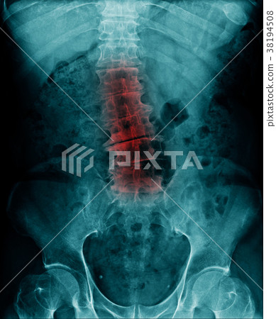 xray lumbar 38194508