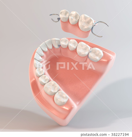 Partial denture Partial denture 38227194