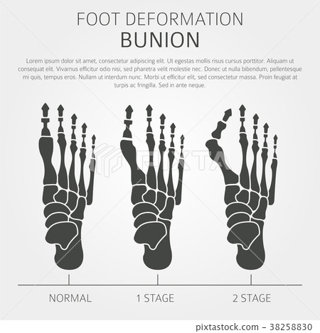 Foot deformation medical bunion infographic 38258830