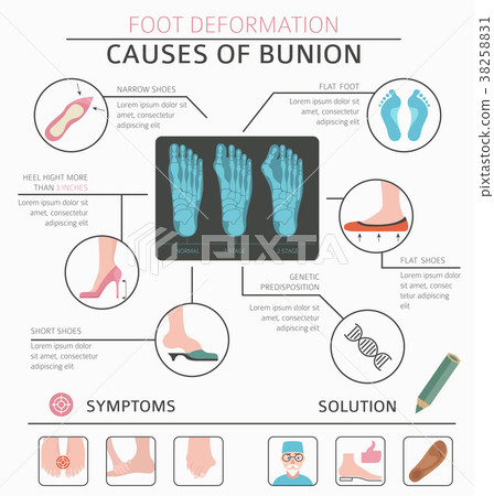 Foot deformation medical bunion infographic 38258831