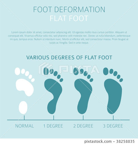 Foot deformation flat foot medical  infographic 38258835