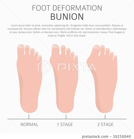 Foot deformation medical bunion infographic 38258840