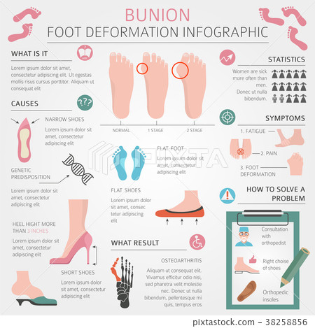 Foot deformation. Bunion infographic - Stock Illustration [38258856 ...
