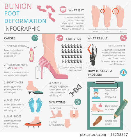 Foot deformation. Bunion infographic 38258857