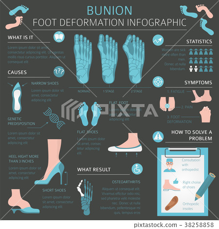 Foot deformation. Bunion infographic 38258858