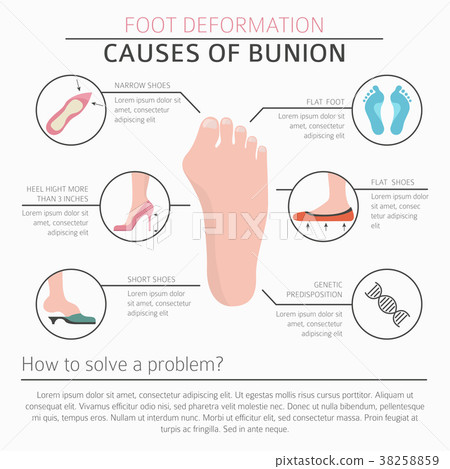 Foot deformation. Bunion infographic 38258859