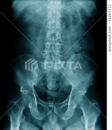 x-ray image show spondylosis and mild compression  38261212