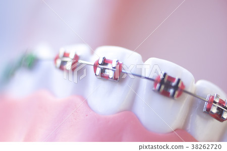 Cosmetic dental metal brackets 38262720