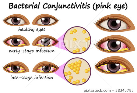 Diagram showing bacterial conjunctivitis Diagram showing bacterial conjunctivitis 38343793