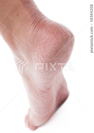dehydrated skin on the heels of female feet dehydrated skin on the heels of female feet 38364208