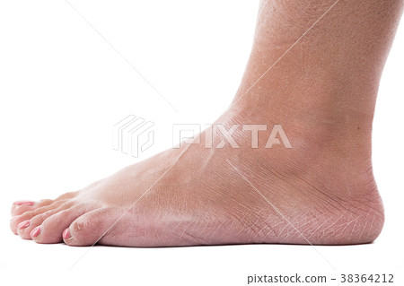 dehydrated skin on the heels of female feet dehydrated skin on the heels of female feet 38364212