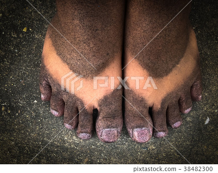 Black spray on the feet. 38482300