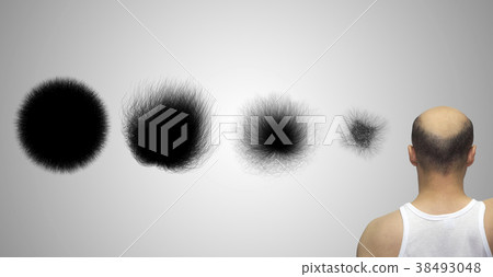 Set of hairstyles showing the hairloss progress. 38493048