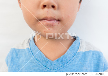 Hand-foot-and-mouth disease  38502800