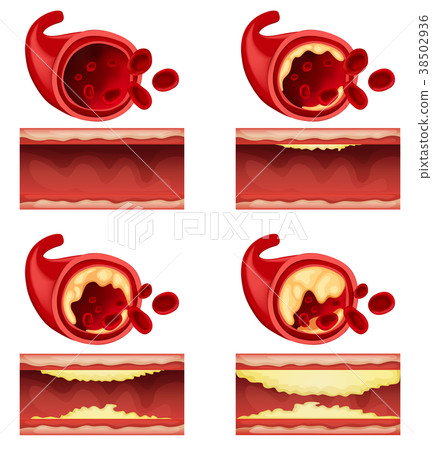 Diagram showing blood clot Diagram showing blood clot 38502936
