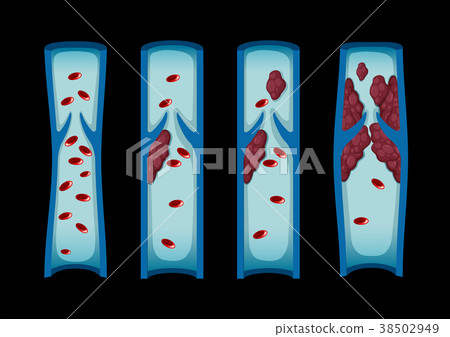 Different stages of blood clot in human 38502949