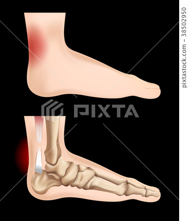 Diagram showing tendon injury 38502950