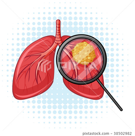 Cancer in human lungs Cancer in human lungs 38502982