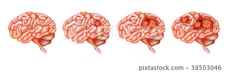 Different stages of cancer in brain - Stock Illustration [38503046] - PIXTA