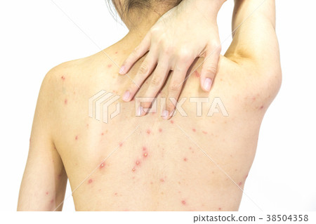 Closeup of Varicella virus or Chicken Pox on white 38504358