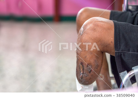 BKA amputation 38509040