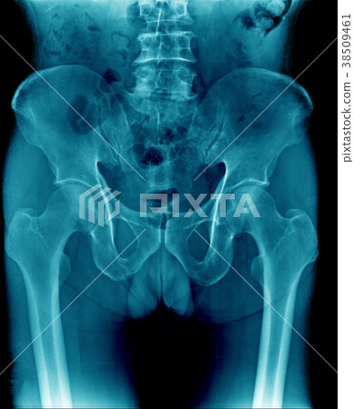 x-ray image pelvic bone and part of femur, spine 38509461