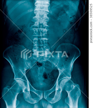 x-ray back scoliosis 38509525