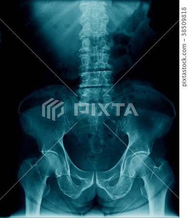 back x-ray 38509818