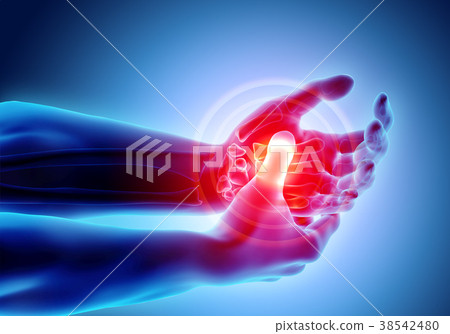 Palm painful - skeleton x-ray, Medical concept. 38542480