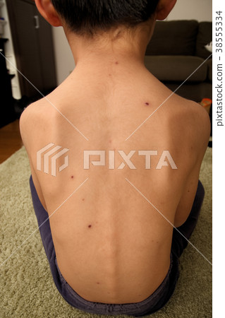 chicken pox 38555334