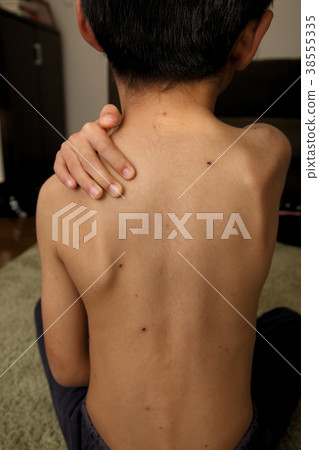 chicken pox 38555335