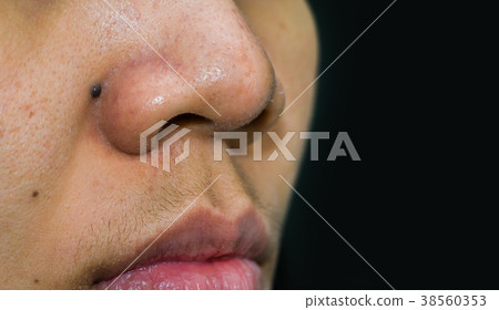 Black mole behind nose need CO2 Laser to removal. 38560353