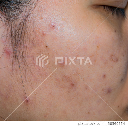 Acne and spot on oily face skin of Asian woman 38560354