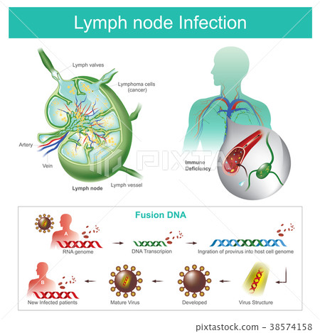 插图素材: the lymph nodes are infected failure