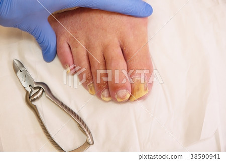 Fungus on the toes nails. Twisted toes Fungus on the toes nails. Twisted toes 38590941