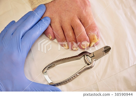 Twisted toes on foot with calluses. Hallux rigidus 38590944