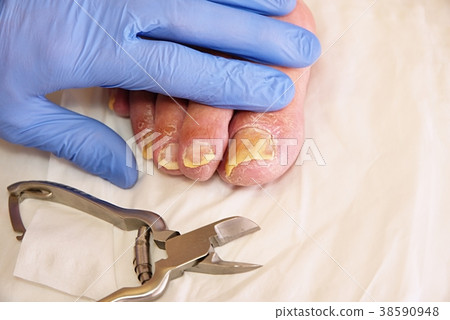 Twisted toes on the foot with calluses. Hallux Twisted toes on the foot with calluses. Hallux 38590948