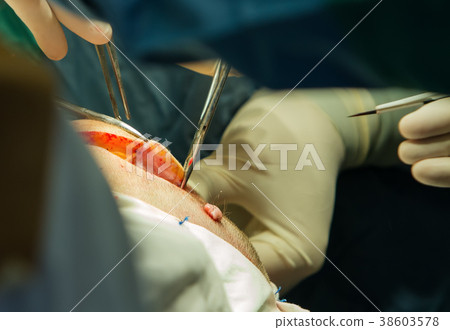 Cutting of the scalp. 38603578