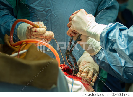 Operation of trepanation of the skull. 38603582