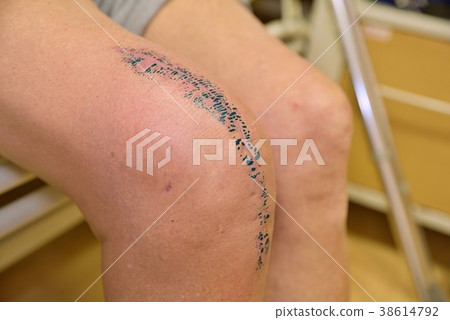 Removed of painful knee joint affected by accident Removed of painful knee joint affected by accident 38614792