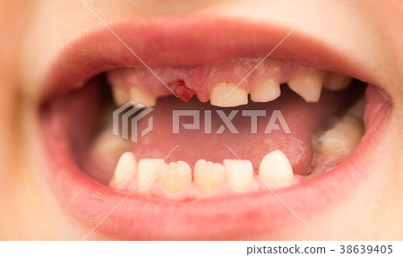 The mouth of a boy without a tooth 38639405
