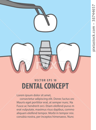 Layout Implant teeth illustration vector 38744657