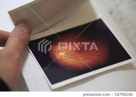 Vitreous hemorrhage Vitreous hemorrhage 38790286