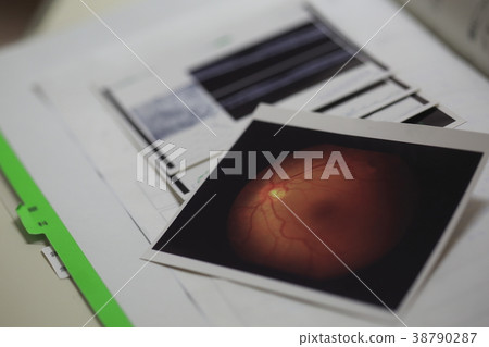 Vitreous hemorrhage 38790287