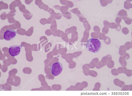 Blast cells of white blood cell. 38830208