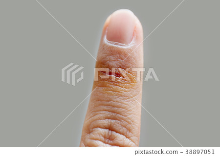 Wound finger injury from accident and first aid Wound finger injury from accident and first aid 38897051