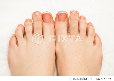 Female toe nails without pedicure. Lack of Female toe nails without pedicure. Lack of 38926876
